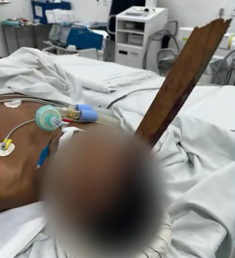 Carpinteiro fica com estaca de madeira cravada no crânio após acidente de trabalho no Rio