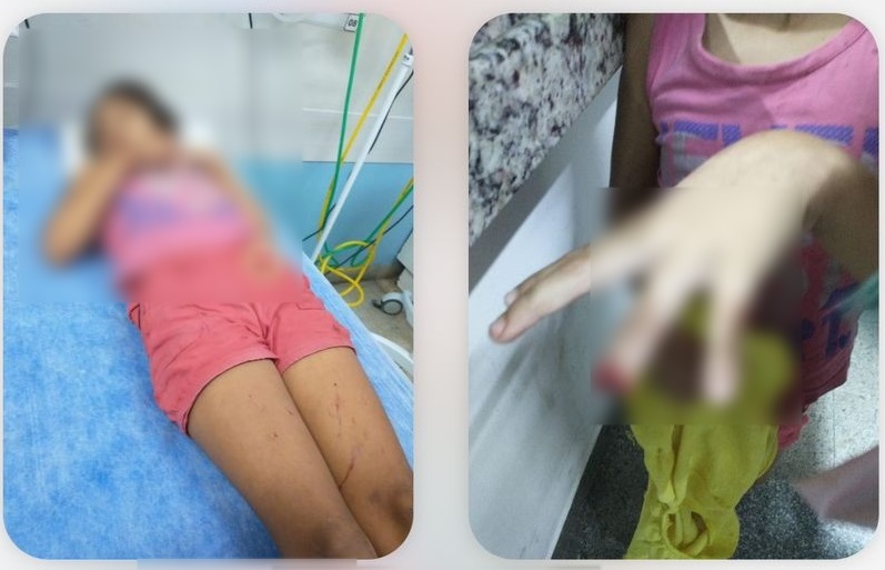 Menina de 8 anos que perdeu parte do dedo é a segunda criança a se acidentar em pracinhas em 40 dias