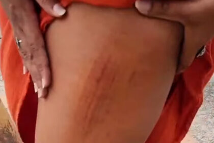 Candidata a vereadora fica ferida após cair dentro de bueiro em Campos
