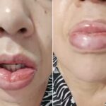 Mais de 1,2 mil pessoas relatam reação a pasta da Colgate; venda segue proibida pela Anvisa