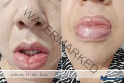 Mais de 1,2 mil pessoas relatam reação a pasta da Colgate; venda segue proibida pela Anvisa