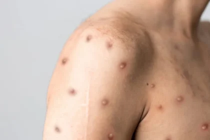 Saúde reforça alerta para Mpox e orienta população sobre sintomas