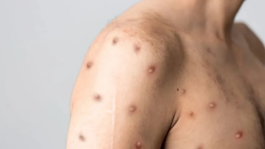 Saúde reforça alerta para Mpox e orienta população sobre sintomas